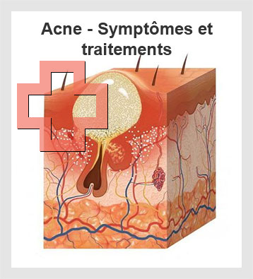 acne symptomes